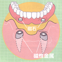 磁石式入れ歯