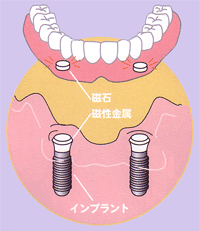固定式インプラント義歯