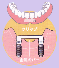 磁石式インプラント義歯
