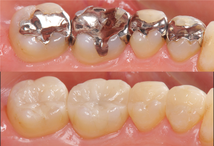 虫歯治療の例