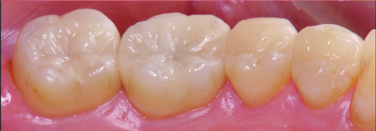 虫歯治療の例