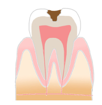 虫歯進行過程_象牙質まで進行