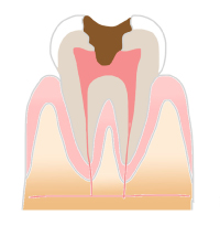 虫歯進行過程_神経まで達した虫歯