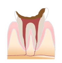 虫歯進行過程_歯の根元まで達した虫歯